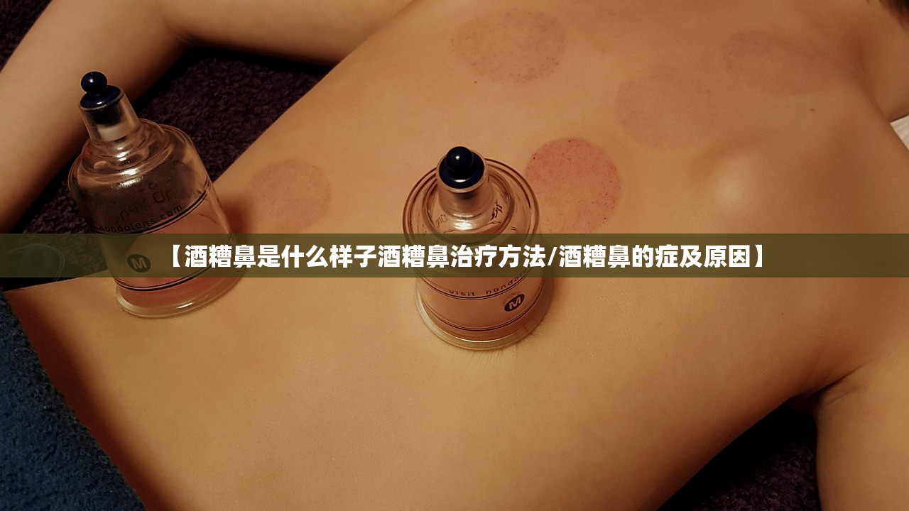 【酒糟鼻是什么样子酒糟鼻治疗方法/酒糟鼻的症及原因】 【酒糟鼻是什么样子酒糟鼻治疗方法/酒糟鼻的症及原因】